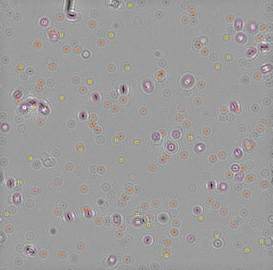Что такое цифровая голографическая микроскопия мочи?